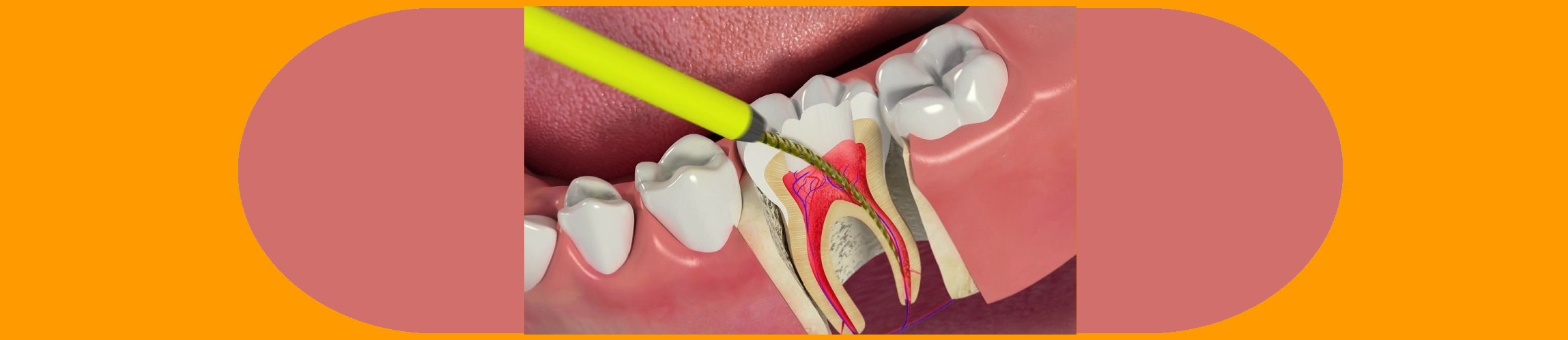 Root Canal Treatment | Root Canal Dentist Near Me | MM ...